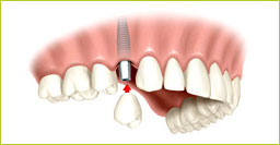 Implants dentals